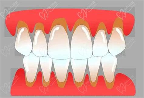 找到了正常牙齿和牙龈萎缩对比图解释下牙龈萎缩能长出来吗 皓齿口腔网