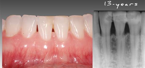 How To Treat A Horizontal Root Fracture Spear Education