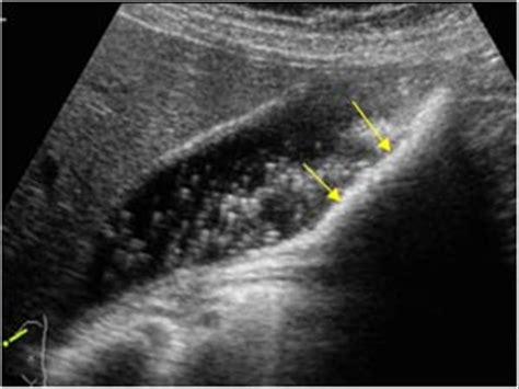 Gallbladder Ultrasound Gallstones