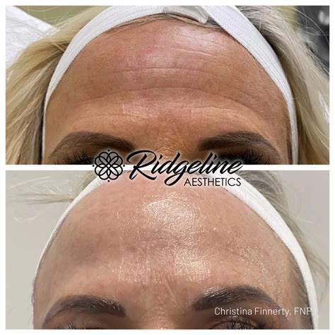 Plasma Skin Tightening Ridgeline Aesthetics A Premier Med Spa