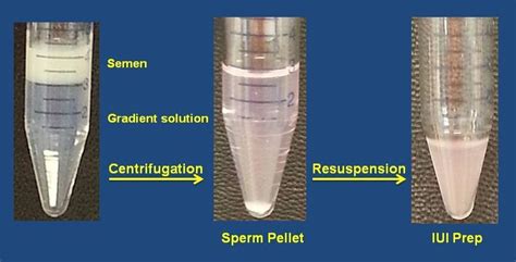 Intrauterine Insemination Iui Queens Fertility And Ivf