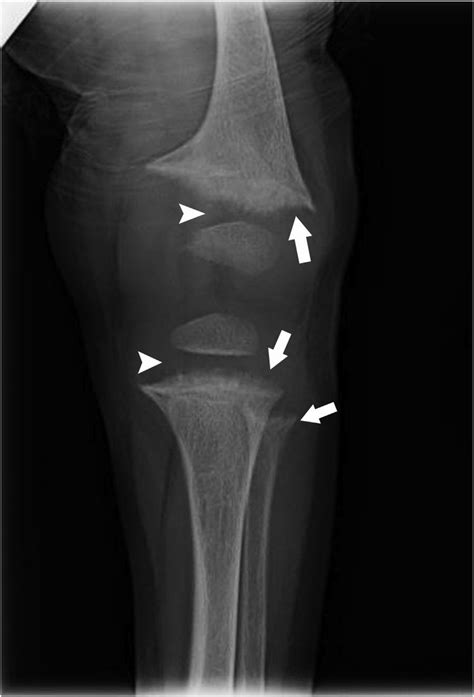 Anteroposterior Radiograph Of Left Lower Extremity Demonstrating