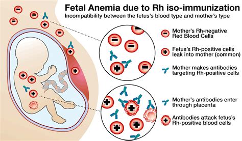 Fetal Anemia And Thrombocytopenia