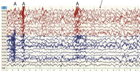 Scalp Video Eeg And Ekg Recording During A Seizure By Patient No 1