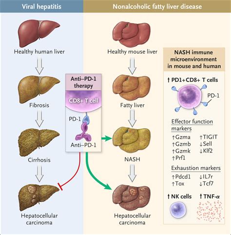 Hepatocellular Carcinoma — Origins And Outcomes Nejm