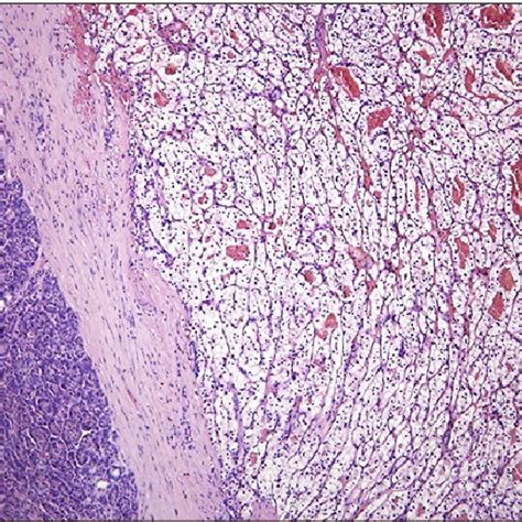 Tumor Proliferation Consisting Of Atypical Cells With Large Clear