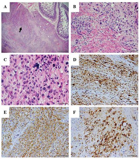 Malignant Peritoneal Mesothelioma In A Patient With Intestinal Fistula