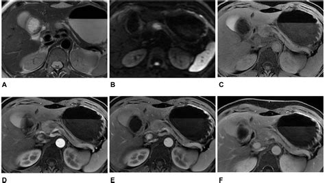 Frontiers Radiomics Analysis Based On Diffusion Kurtosis Imaging And