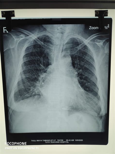 Chest X Rays