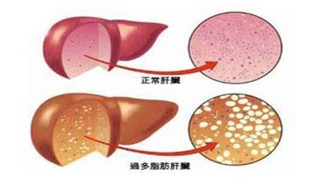 忽略脂肪肝可能变成肝硬化，医生告诉你这样做可以逆转 知乎