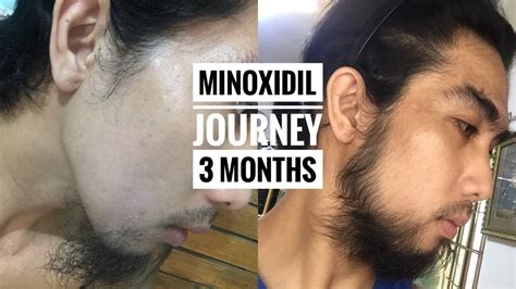 Minoxidil Beard Journey Pinoy Week 5 16 Philippines Youtube