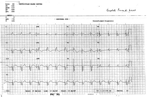 Myocarditis Ecg Dr Smiths Ecg Blog Ecg Of Pneumopericardium And