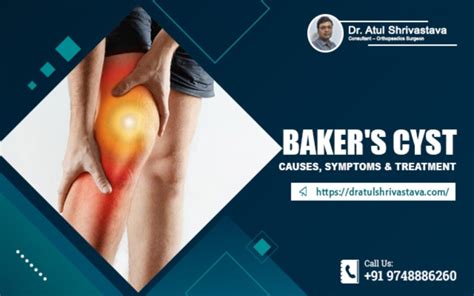 Bakers Cyst Causes Symptoms And Treatment Dr Atul Shrivastava