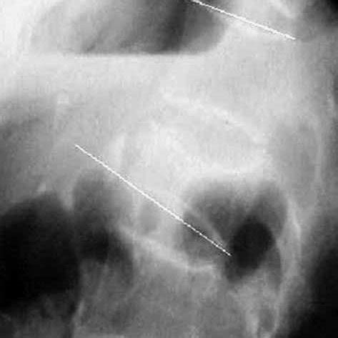 Female, 80 years, L1#, 4 months old, vertebra plana : (a)... | Download Scientific Diagram