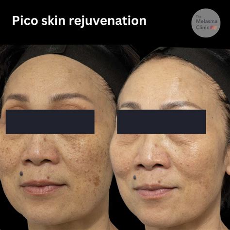 The Glow Series Skin Rejuvenation Dr Davin Lim Dermatologist