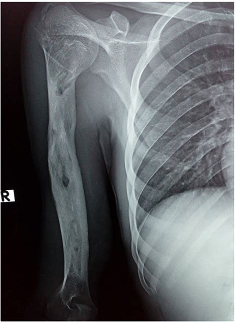 AP view X-ray of the right humerus after 11 month follow up show good ...