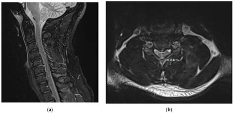 Lumbar Spine Mri Bulging Disc