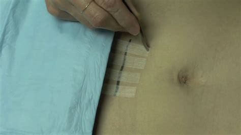 Steri Strip Removal After Tubal Ligation Reversal Youtube