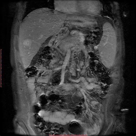 Hemangioma In A Cirrhotic Liver Image