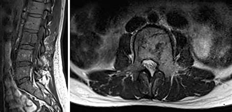 Frontiers Imaging Findings And Clinical Features Of Primary Spinal