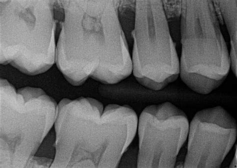 How To Take Perfect Dental X Rays Tips And Tricks