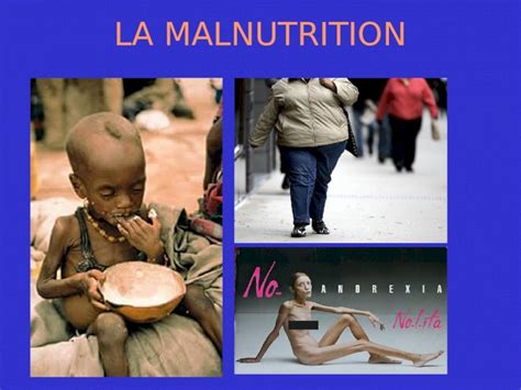 Ppt La Malnutrition La Malnutrition La Malnutrition D Signe Un Tat