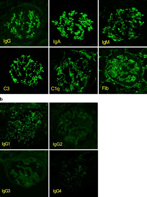 Figure A Immunofluorescent Microscopy Showed Granular Deposition Of