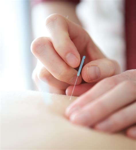 Dry Needling/IMS - Cochrane Chiropractor - Bow River Chiropractic