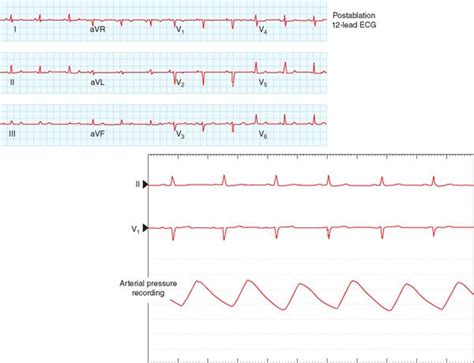 Diagnostic Maneuvers For Supraventricular Tachycardia Pvc On His And Para Hisian Pacing