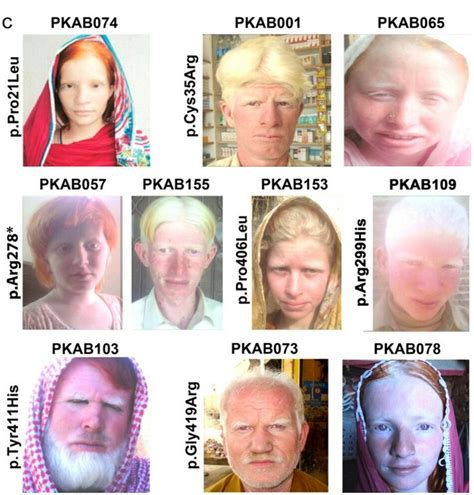 Albino Genetic Variation Black History Books White People American