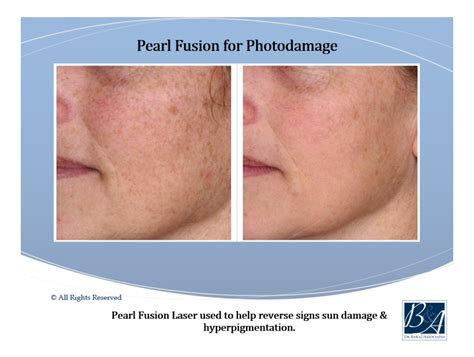 Pearl Fusion And Pearl Fractional Laser Dr Bawa And Associates