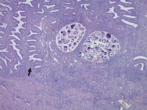 Sections Of The Endometrium Shows Benign Proliferative Endometrial