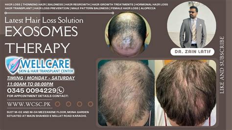 Latest Hair Loss Solution Exosome Therapy Hair Regrowth Treatment In