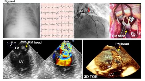 Acute Mitral Regurgitation Heart