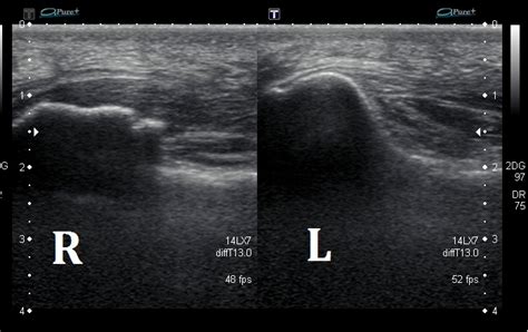 Ultrasound Images of Plantar Fasciitis - Ankle, Foot and Orthotic Centre