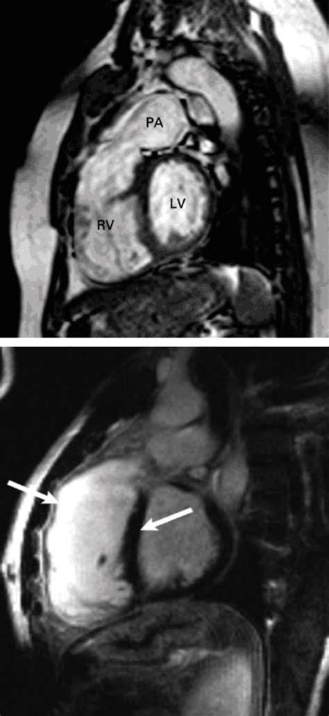 Chapter 25 – Surgery for Adult Congenital Heart Disease | Thoracic Key