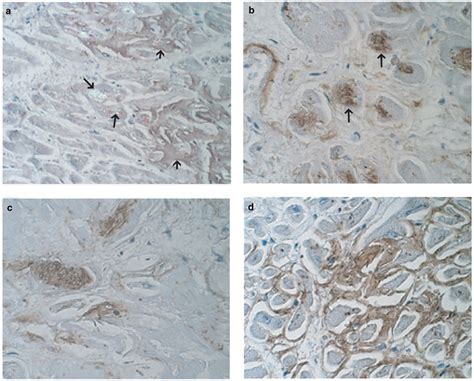 Two Different Types Of Amyloid Deposits—apolipoprotein A Iv And