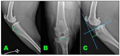 Maquet Osteotomy Dr Rahul Bade