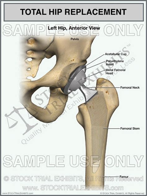 Total Hip Replacement of the Left Hip – Stock Trial Exhibits