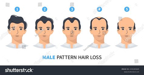 Hair Loss Stages Androgenetic Alopecia Male Stock Vector Royalty Free