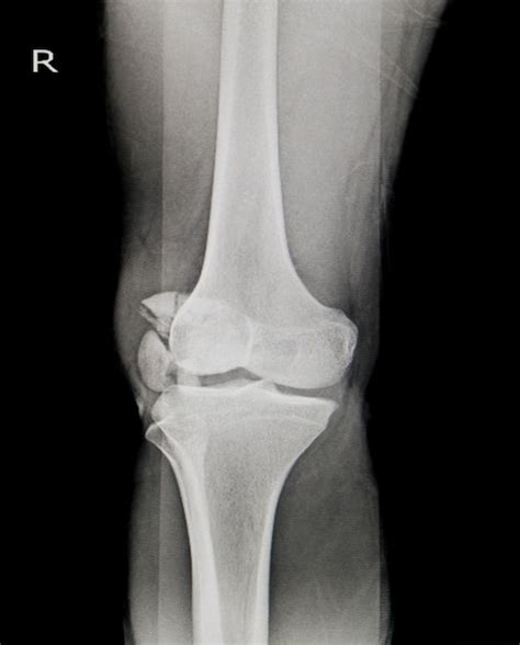 Premium Photo | X-ray knee ap-lateral showing fracture patella or knee cap.