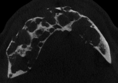 Of Ultrasonography In Maxillofacial Intraoral Benign And Malignant