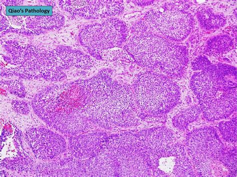 Qiaos Pathology Basaloid Squamous Cell Lung Carcinoma Flickr