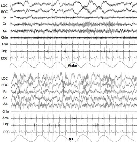 A 62 Year Old Man With Facial And Finger Twitching Journal Of