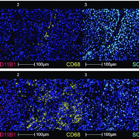 Recruitment Of HSD11B1 Macrophages In Human Melanoma Under ICI