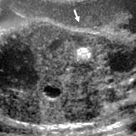 Prenatal Ultrasound Intraabdominal Calcifications With Meconium