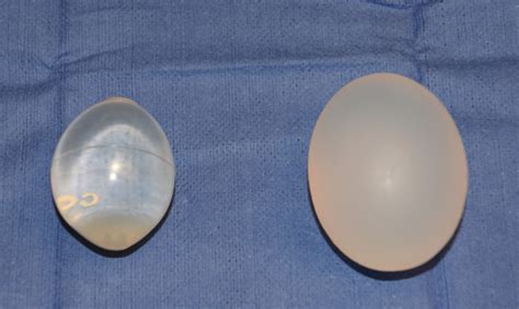 Saline Vs Silicone Testicle Implant Dr Barry Eppley Indianapolis