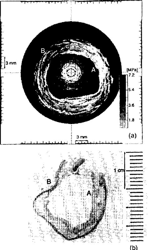 Figure 1 From Imaging Of Cross Sectional Elasticity Of Arterial Wall Using Intravascular