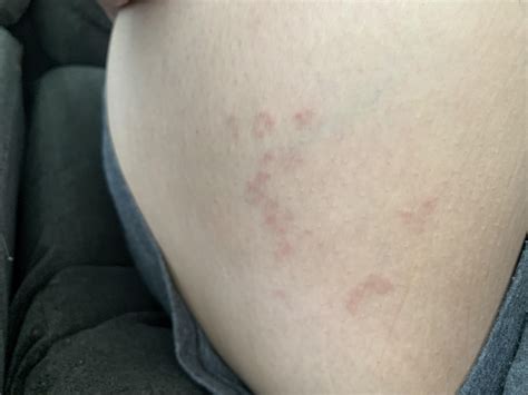 Skin Rash Inner Thigh Rdermatologyquestions