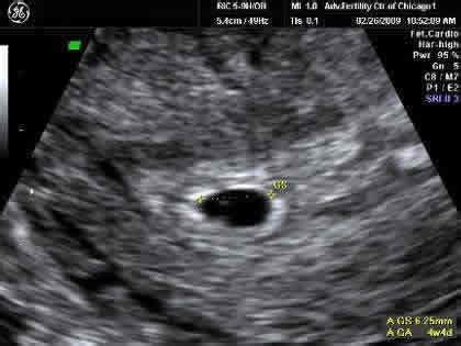 5 Week Ultrasound Pictures | New Health Advisor